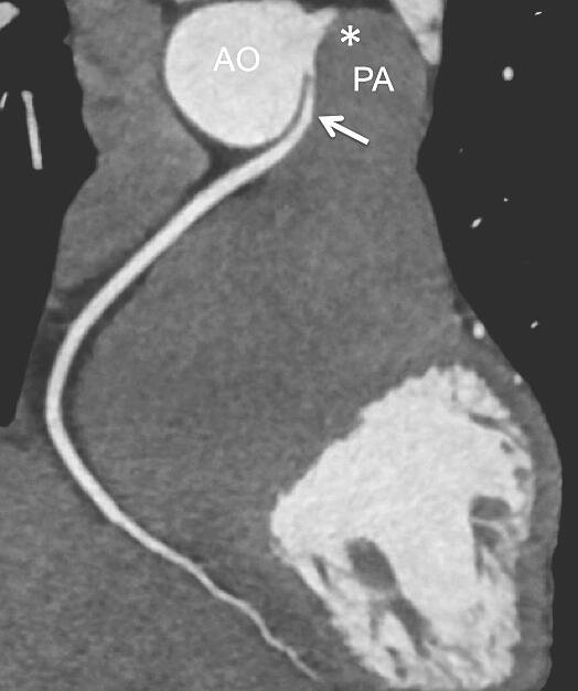Abbildung 1: Darstellung der rechten Koronararterie (RCA) in der CT-Angiographie: Die RCA tritt schlitzförmig (Pfeil) neben dem Hauptstamm (Stern) aus dem linken Aortensinus und verläuft intramural zwischen der Aorta (AO) und der Pulmonalarterie (PA).
