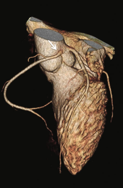 Abbildung 2: Dreidimensionale CT-Angiographie-Darstellung der rechten Herzkranzarterie (Pfeil).