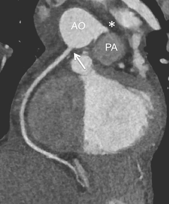 Abbildung 3: Postoperative CT-Angiographie mit Darstellung von Aorta, rechter Koronararterie (Pfeil) und linkem Hauptstamm (Stern). Die rechte Herzkranzarterie ist in den rechten Aortensinus reimplantiert (Pfeil; AO: Aorta; PA: Pulmonalarterie).