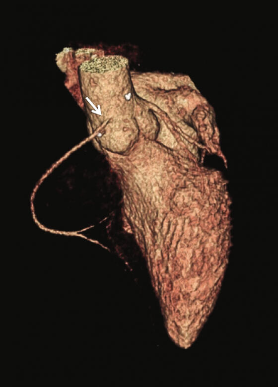 Abbildung 4: Dreidimensionale CT-Angiographie-Darstellung der in den rechten Aortensinus replatzierten rechten Koronararterie (Pfeil).