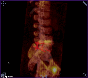 SPECT CT Wirbelsäule Radiologie Nuklearmedizin