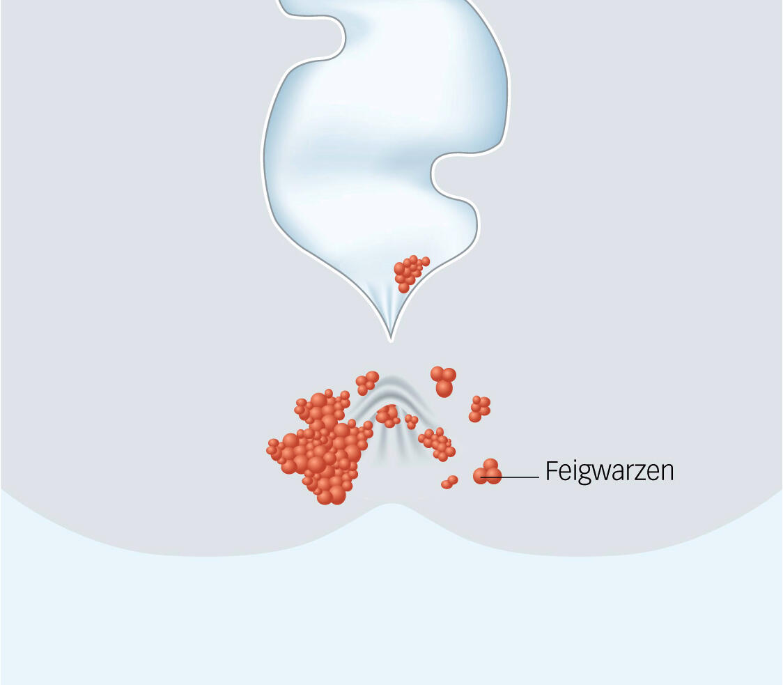 LUKS Koloproktologie Feigwarze