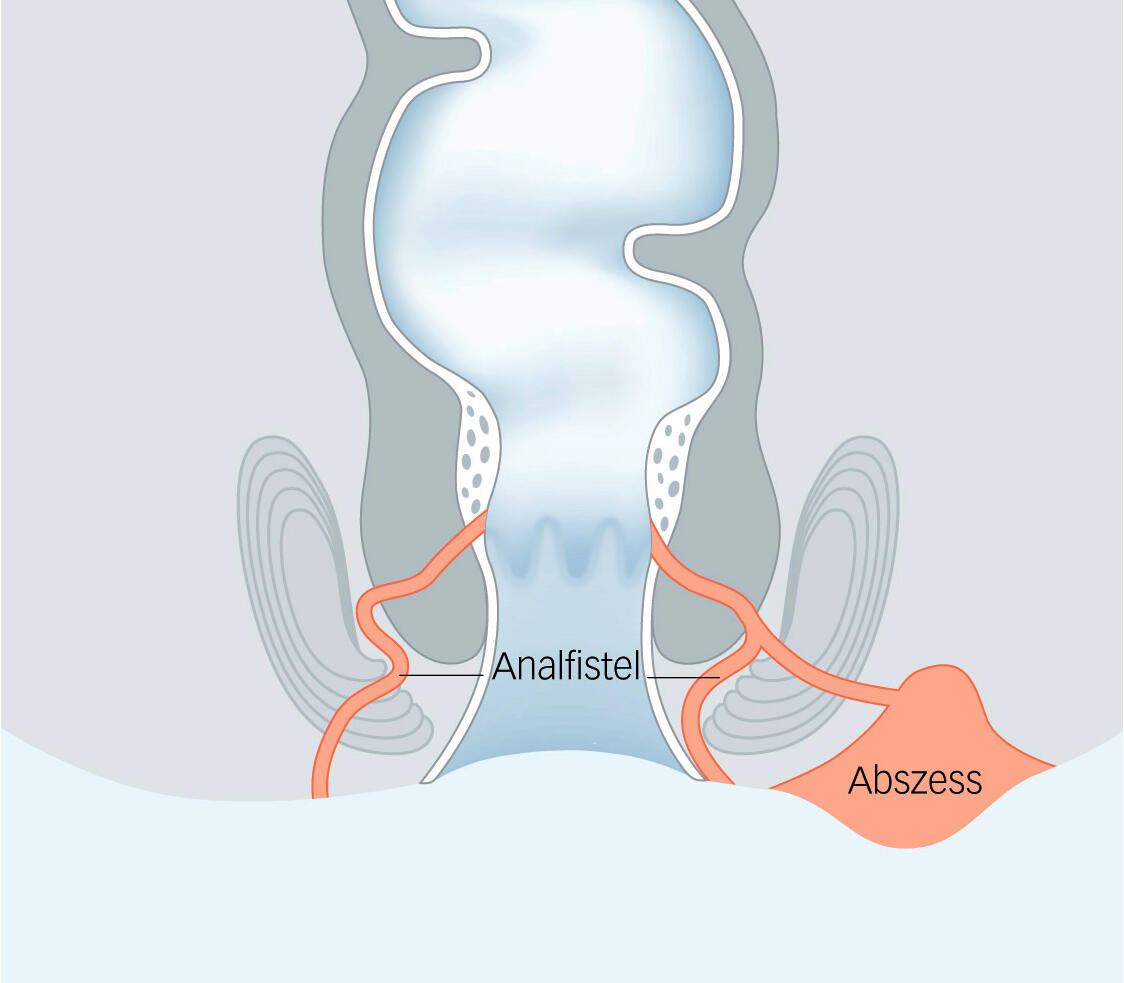 LUKS Zeichnungen Koloproktologie Fistel Abszess