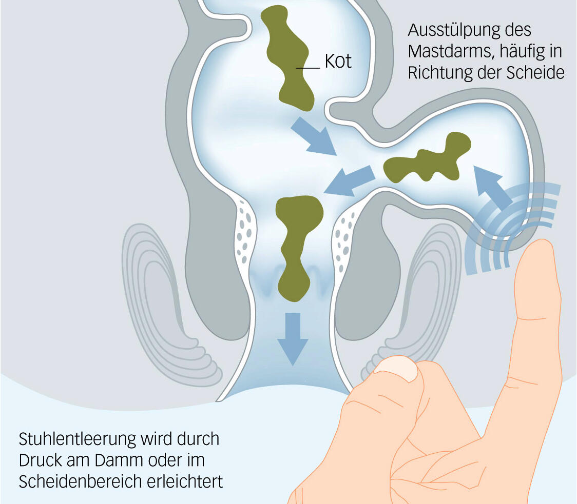 LUKS Zeichnungen Koloproktologie Rektozele