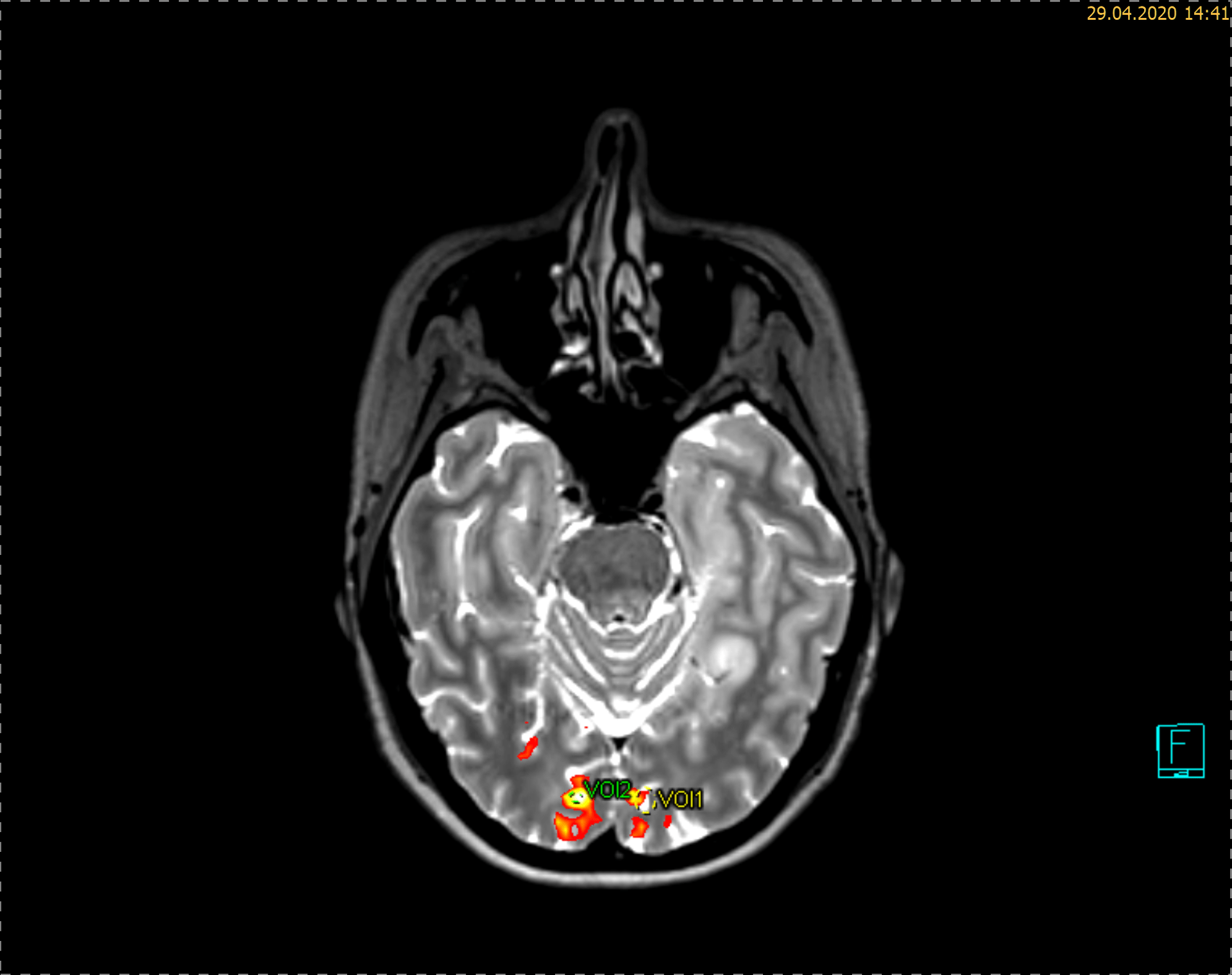 activiation synonyms vis cortex