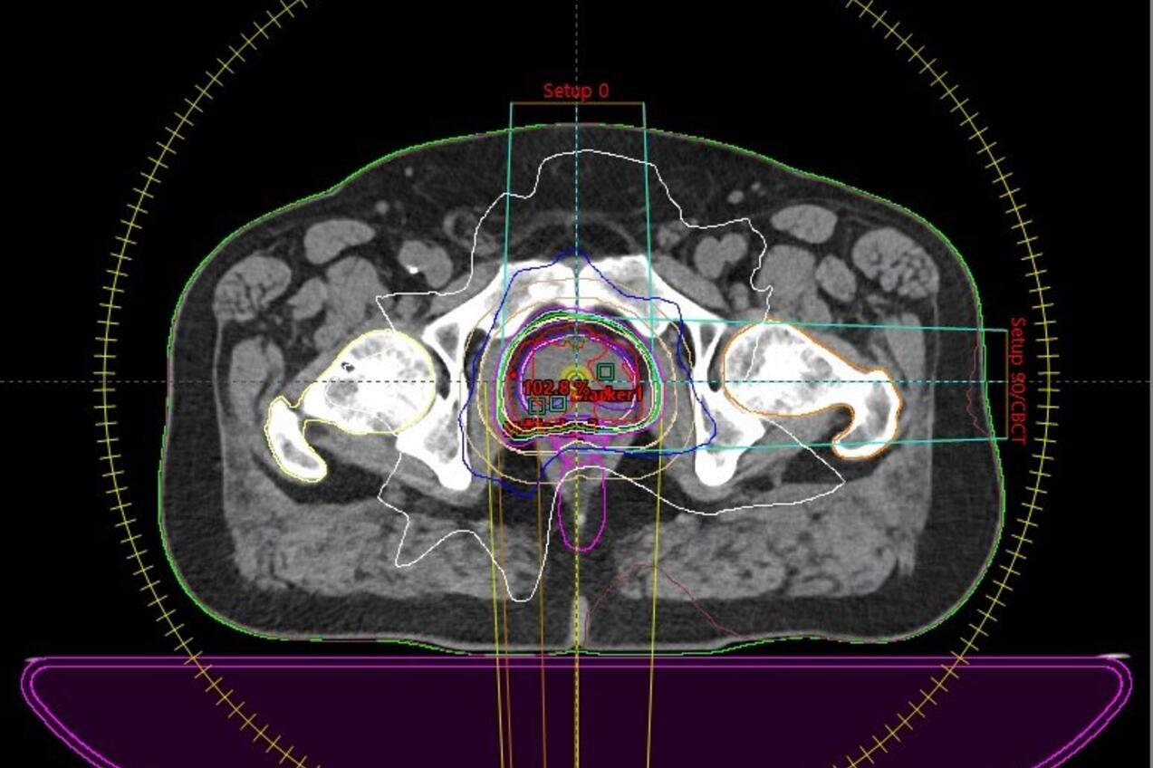 VMAT Bestrahlungsplan basierend auf CT Bilddatensatz: PTV, Risikoorgane, Isodosenverteilung