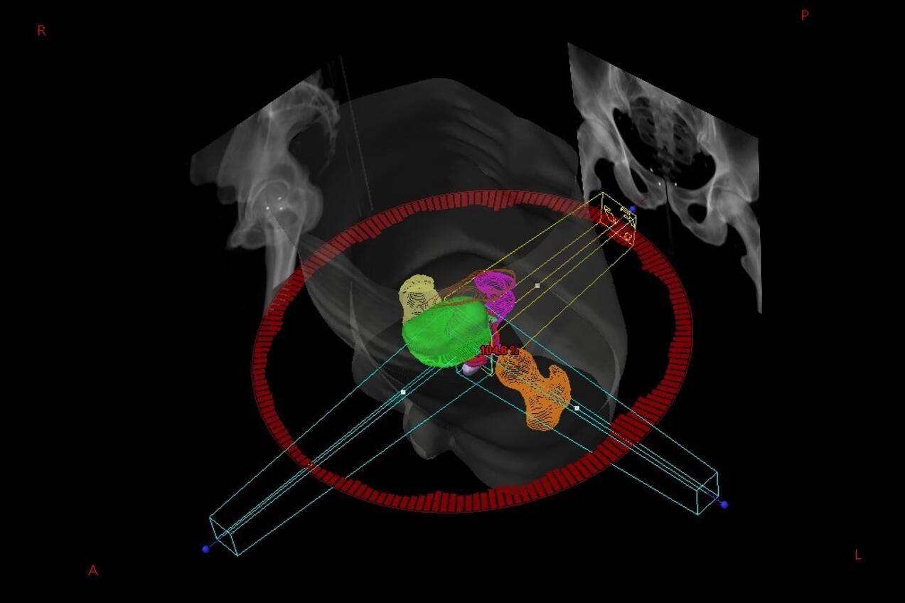 3D Ansicht Bestrahlungsplan mit eingezeichneten Strukturen und Projektionen der Verifikationsbilder (DRR)
