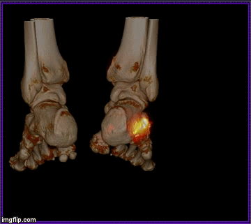 SPECT CT Fuss Radiologie Nuklearmedizin