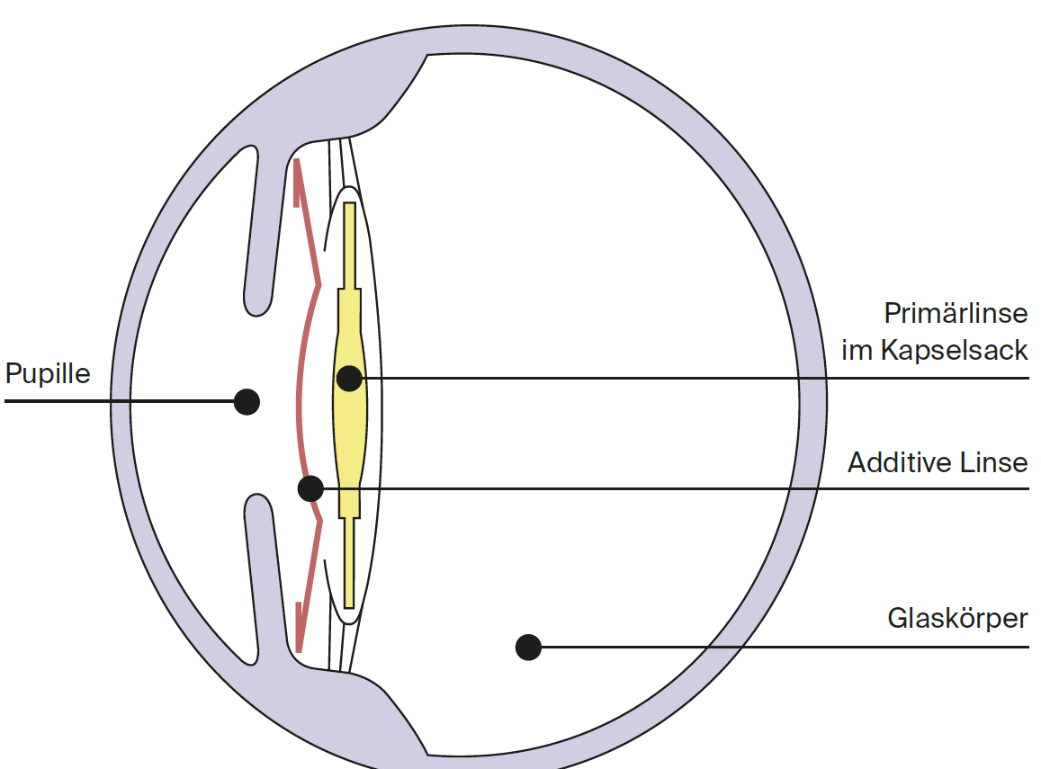 Auge im Längsschnitt Augenklinik