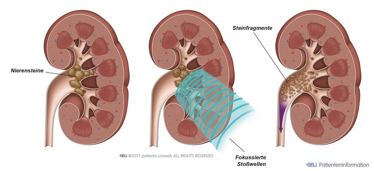 Nierensteine 2 Behandlung Luzerner Kantonsspital