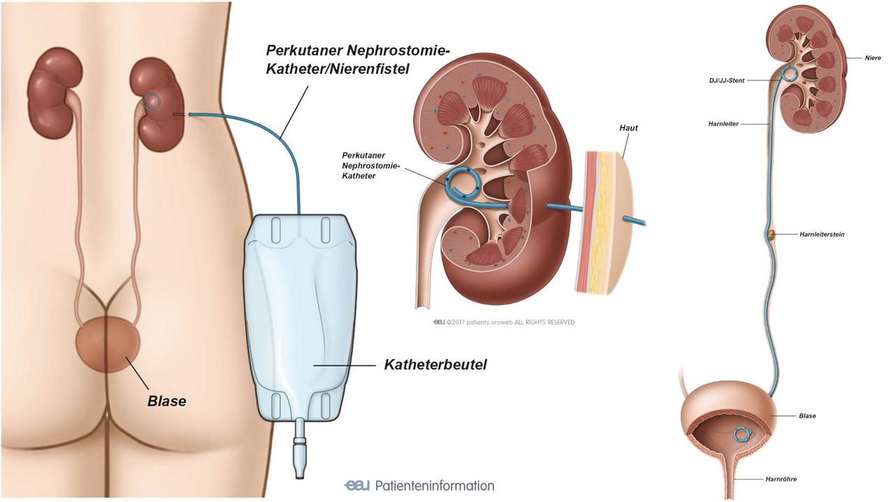 Nierensteine 2 Behandlung Luzerner Kantonsspital