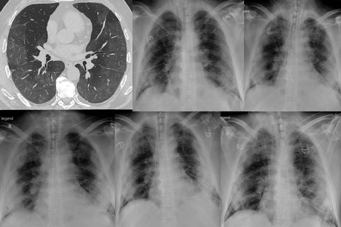 Röntgenbild flecken lunge weiße Röntgen